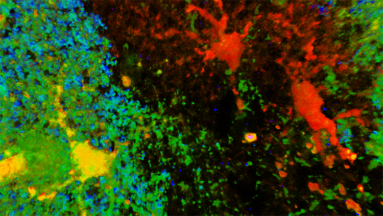 How Concussions May Lead to Epilepsy